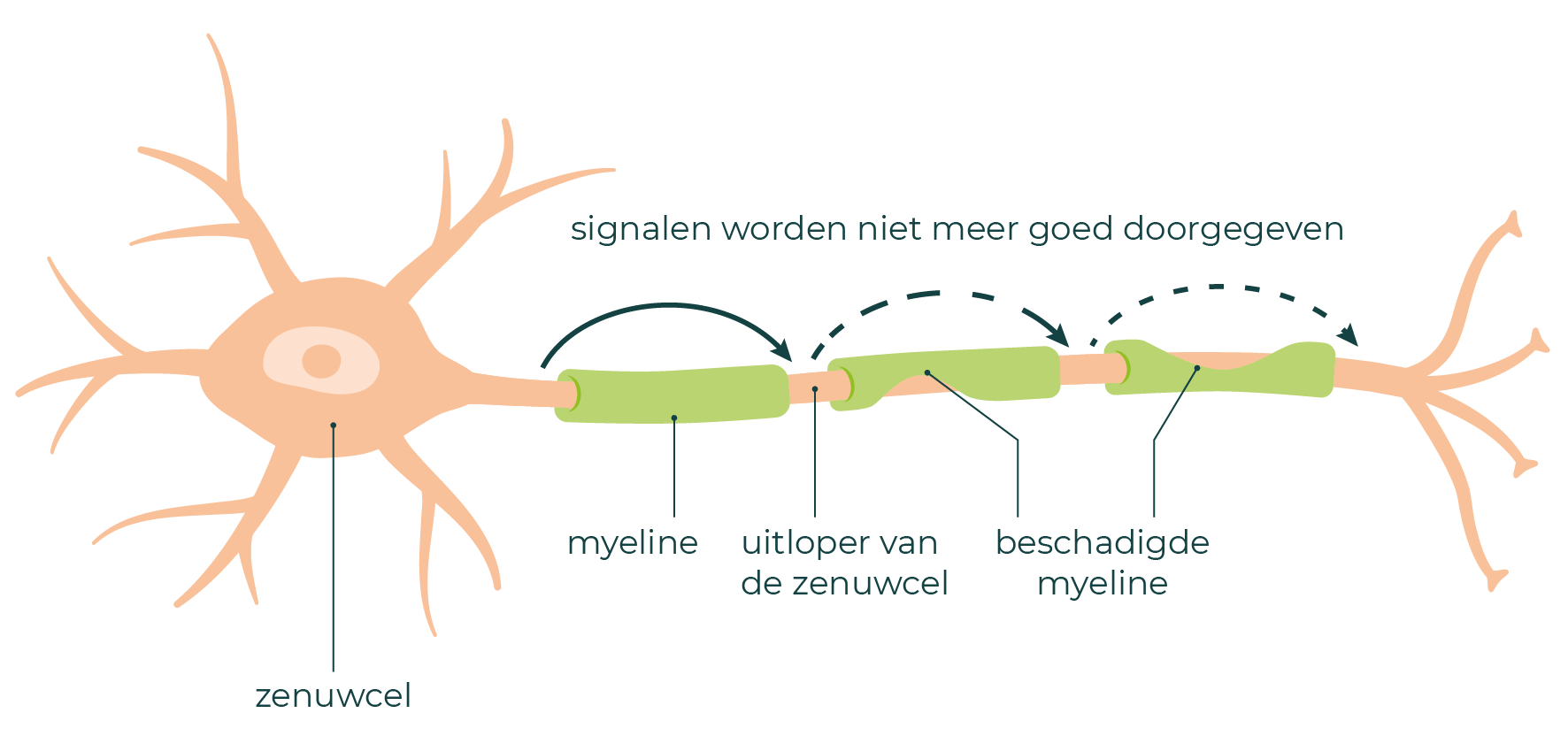 Een zenuw met zenuwuitloper. De myeline rondom de zenuwuitloper is beschadigd.