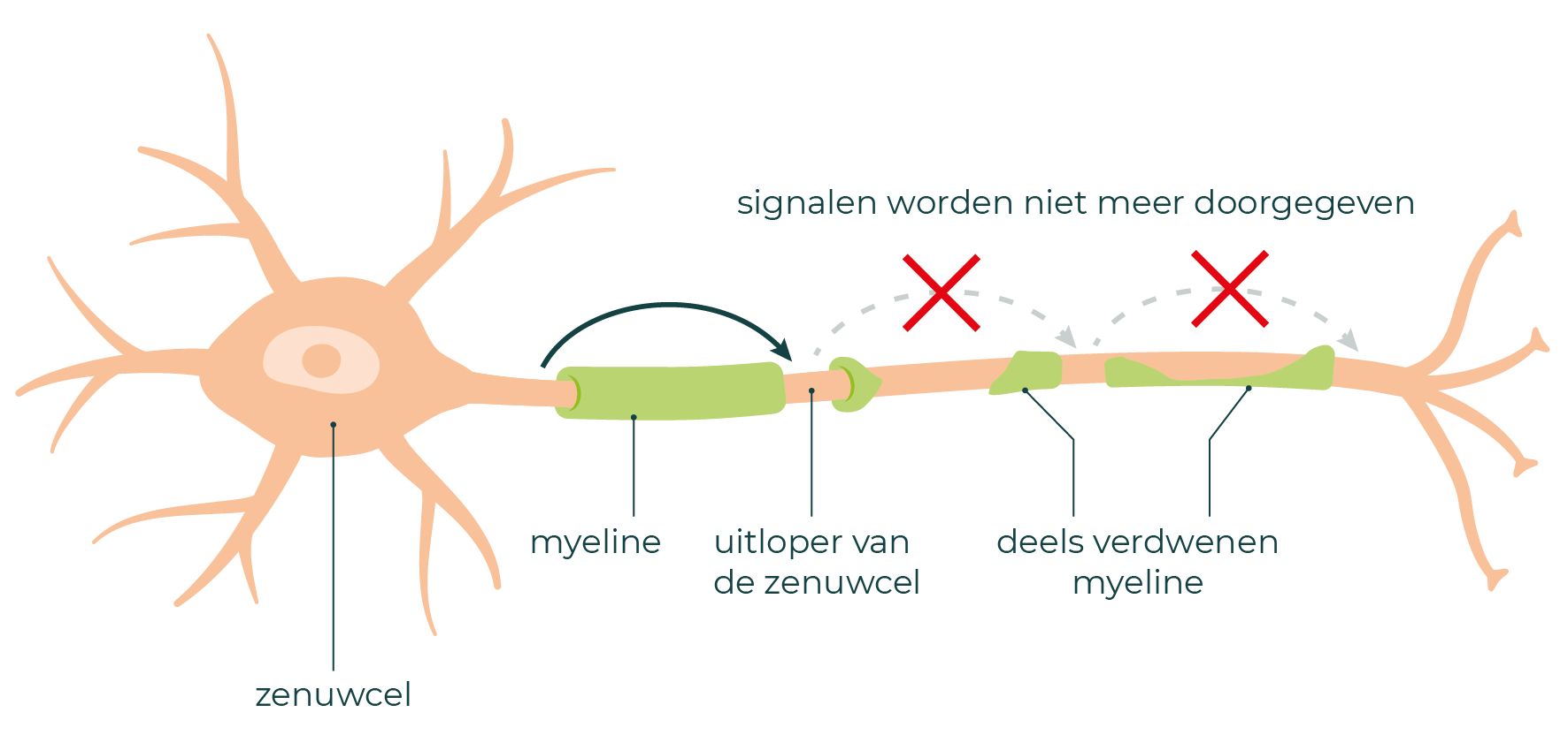Een zenuw met zenuwuitloper. De myeline rondom de zenuwuitloper is erg beschadigd. De signalen worden niet meer doorgegeven.
