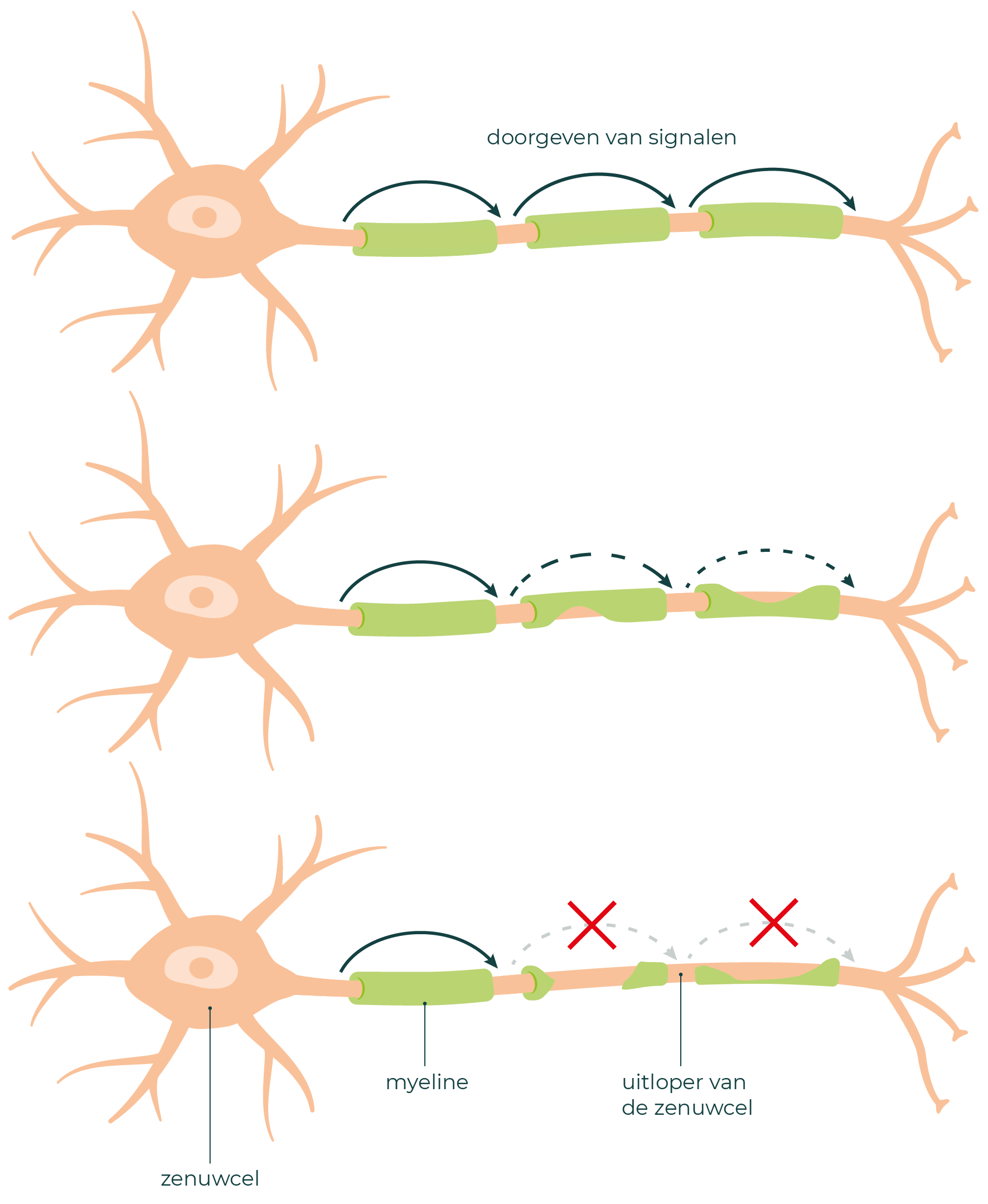 Drie keer een zenuwcel. In de bovenste zenuwcel is de myeline nog heel. Bij de andere twee is de myeline steeds verder beschadigd.