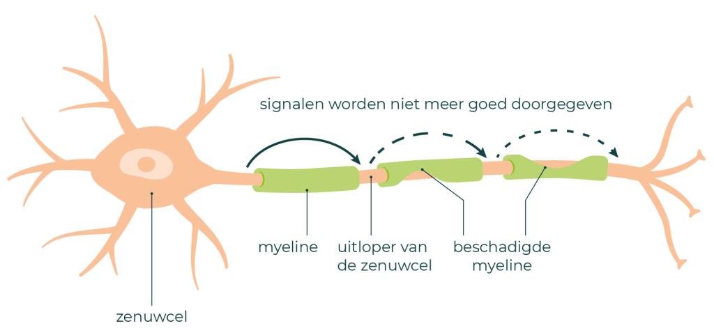 Zenuwcel en myeline - signalen worden niet meer goed doorgegeven