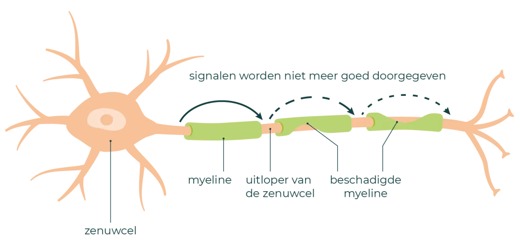 Een zenuw met zenuwuitloper. De myeline rondom de zenuwuitloper is beschadigd.