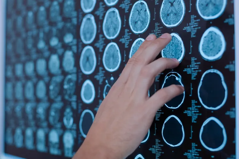 Therapieën bij cognitieve problemen en vermoeidheid: wat helpt?